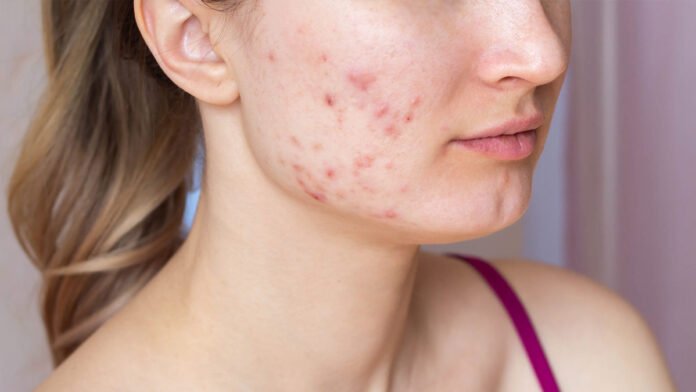 Acne and Pimples
