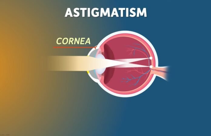 Astigmatism Eye Defects 